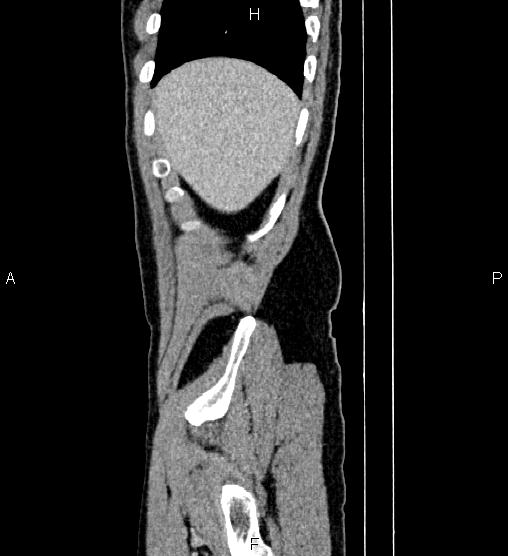Adrenal myelolipoma (Radiopaedia 87794-104246 Sagittal renal cortical phase 9).jpg