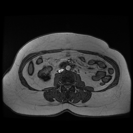 File:Adrenal myelolipoma - MRI (Radiopaedia 83249-97646 T1 out-of-phase 21).jpg