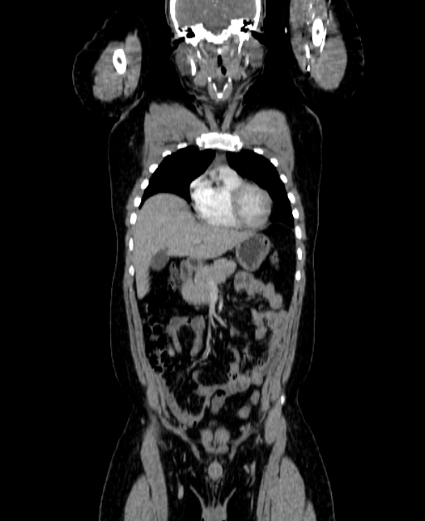 Adrenocortical carcinoma (Radiopaedia 80134-93438 Coronal C+ portal venous phase 55).jpg