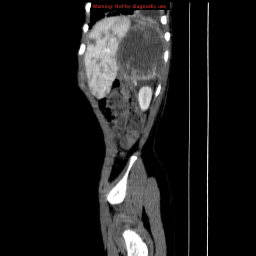 File:Adrenocortical carcinoma (Radiopaedia 9449-10131 Sagittal C+ portal venous phase 18).jpg