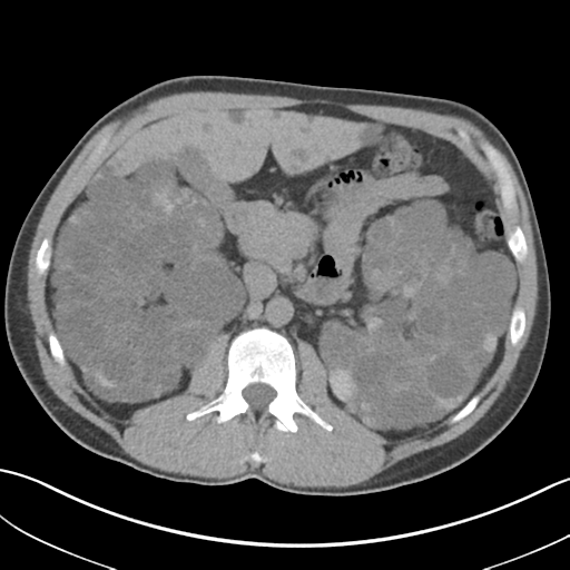 File:Adult polycystic kidney disease (Radiopaedia 47866-52626 Axial non-contrast 31).png