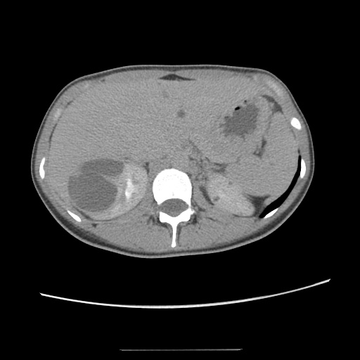 File:Adult polycystic kidney disease (Radiopaedia 48845-53876 Axial renal excretory phase 30).jpg