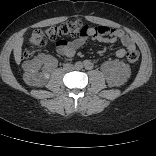 Adult polycystic kidney disease (Radiopaedia 59075-66368 Axial non-contrast 49).jpg