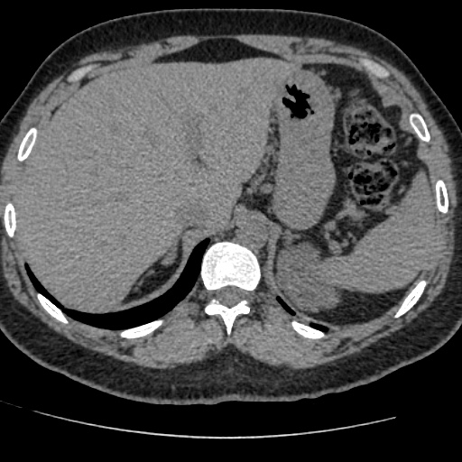 Adult polycystic kidney disease (Radiopaedia 59075-66368 Axial non-contrast 6).jpg