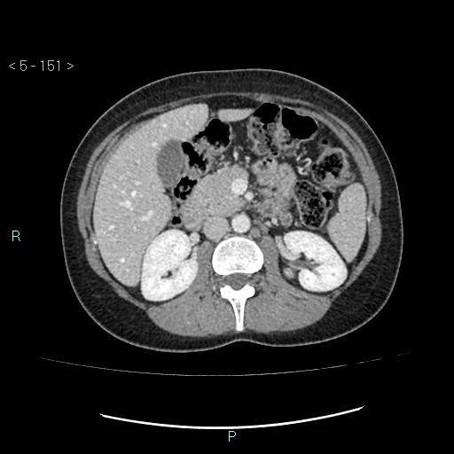 Adult transient intestinal intussusception (Radiopaedia 34853-36310 Axial C+ portal venous phase 18).jpg