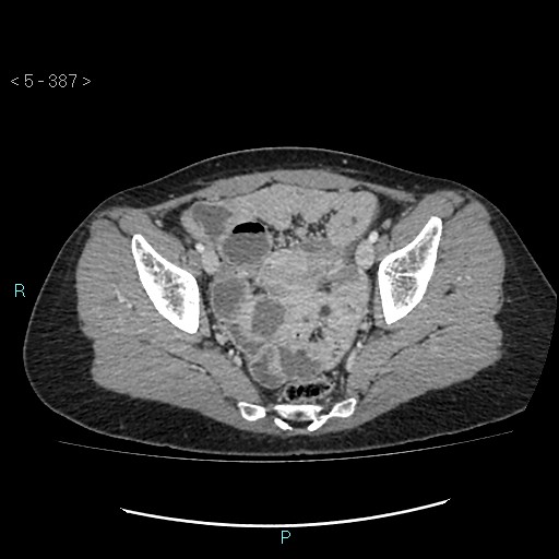Adult transient intestinal intussusception (Radiopaedia 34853-36310 Axial C+ portal venous phase 99).jpg
