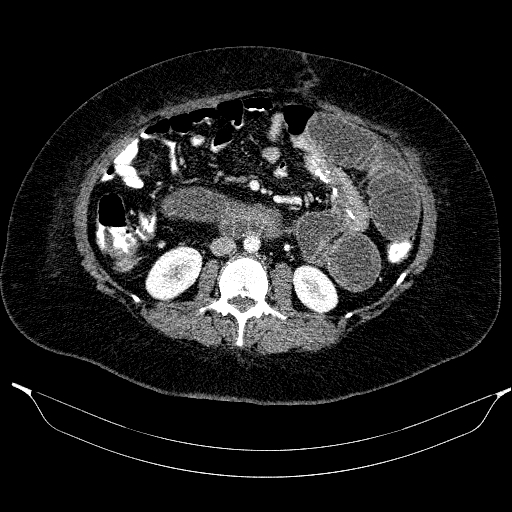 File:Afferent loop syndrome - secondary to incarcerated trocar site hernia (Radiopaedia 82959-97305 Axial C+ portal venous phase 115).jpg