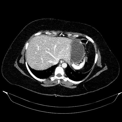 Afferent loop syndrome - secondary to incarcerated trocar site hernia (Radiopaedia 82959-97305 Axial C+ portal venous phase 35).jpg