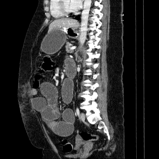 Afferent loop syndrome - secondary to incarcerated trocar site hernia (Radiopaedia 82959-97305 Sagittal C+ portal venous phase 67).jpg