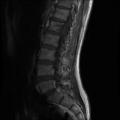 File:Aggressive vertebral hemangioma with pathological fracture (Radiopaedia 69528-79411 Sagittal T1 4).jpg