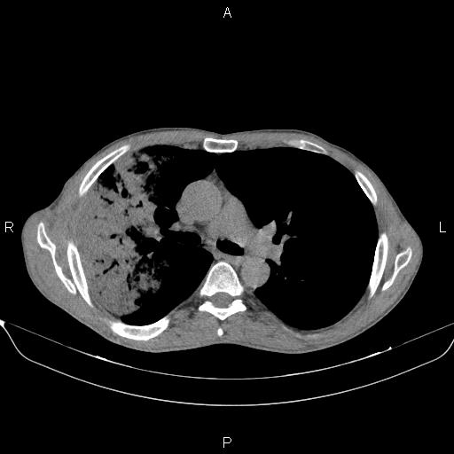 Air bronchogram in pneumonia (Radiopaedia 85719-101512 Axial non-contrast 29).jpg