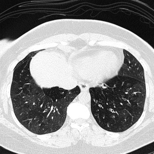 Air trapping in small airway disease (Radiopaedia 61685-69694 Axial lung window 140).jpg