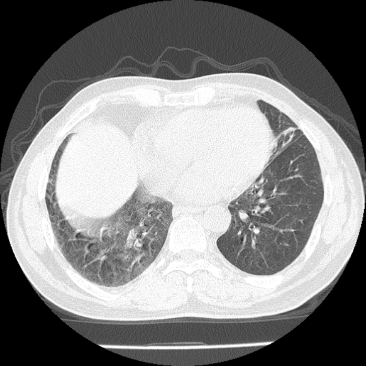 Airway foreign body in adult (Radiopaedia 85907-101779 Axial lung window 129).jpg