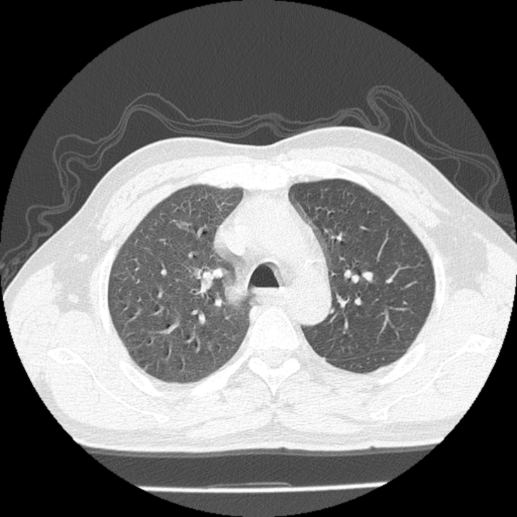 Airway foreign body in adult (Radiopaedia 85907-101779 Axial lung window 42).jpg