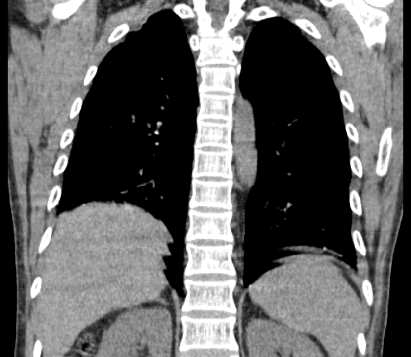 Airway foreign body in adult (Radiopaedia 85907-101779 Coronal liver window 197).jpg