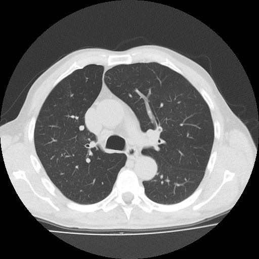 Allergic bronchopulmonary aspergillosis (ABPA) (Radiopaedia 60594-68313 Axial lung window 22).jpg