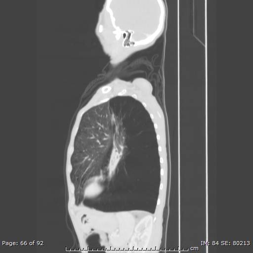 File:Alpha-1-antitrypsin deficiency (Radiopaedia 50561-55987 Sagittal lung window 32).jpg