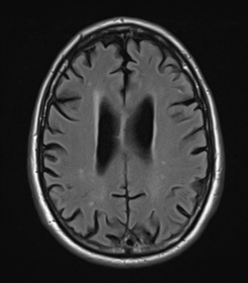 File:Alzheimer's disease- with Gerstmann syndrome and dressing apraxia (Radiopaedia 54882-61150 Axial FLAIR 19).png