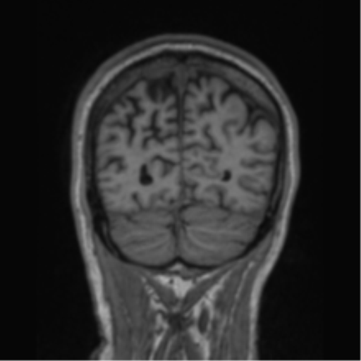 File:Alzheimer's disease- with apraxia (Radiopaedia 54763-61011 Coronal T1 22).png