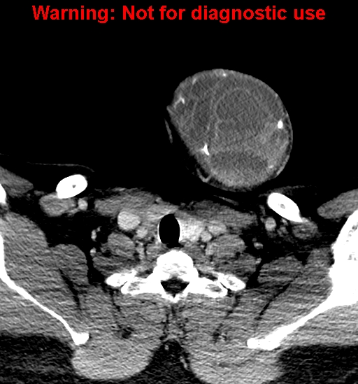File:Ameloblastoma (Radiopaedia 33126-34164 B 37).jpg