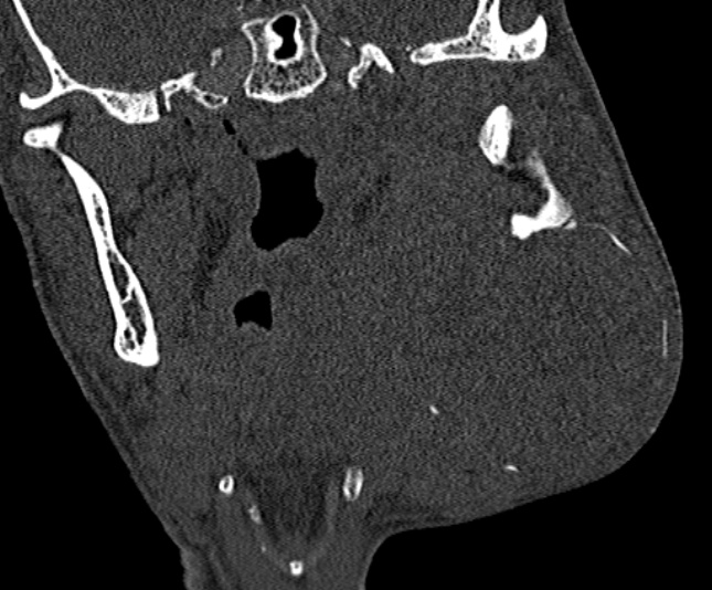 Ameloblastoma (Radiopaedia 51921-57766 Coronal bone window 161).jpg