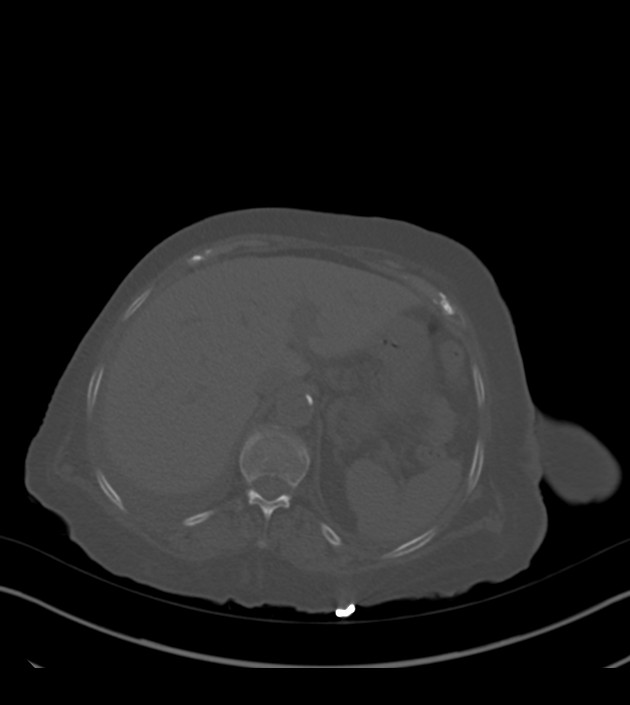 Amiodarone deposition in the liver (Radiopaedia 77587-89780 Axial bone window 77).jpg