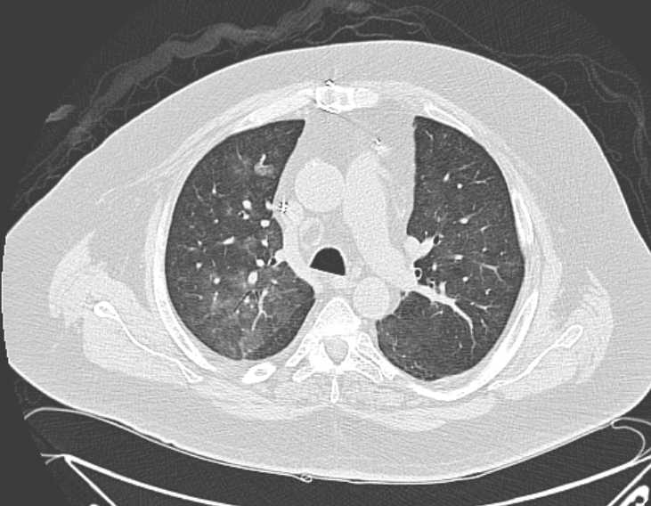 Amiodarone lung (Radiopaedia 62514-70769 Axial lung window 33).jpg