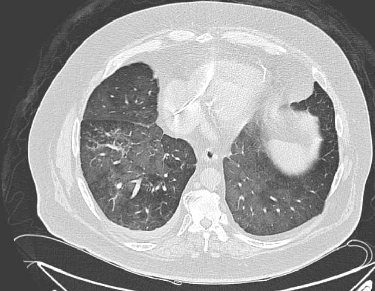 Amiodarone lung (Radiopaedia 62514-70769 Axial lung window 65).jpg