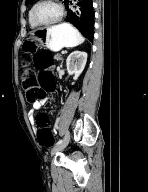 Ampullary adenocarcinoma (Radiopaedia 86093-102032 D 66).jpg