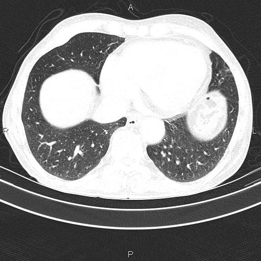 Ampullary adenocarcinoma (Radiopaedia 86093-102033 Axial lung window 44).jpg