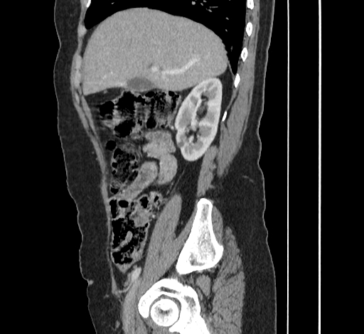 Ampullary tumor (Radiopaedia 60333-67998 C 15).jpg