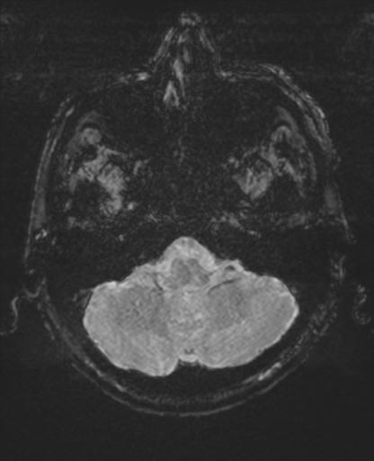 Amyloid angiopathy with inflammation (Radiopaedia 30360-31002 Axial SWI MAG 3).jpg