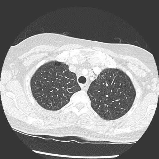 File:Amyloidosis - bronchial and diffuse nodular pulmonary involvement (Radiopaedia 60156-67745 Axial lung window 14).jpg