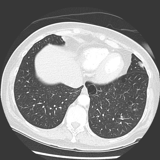 Amyloidosis - bronchial and diffuse nodular pulmonary involvement (Radiopaedia 60156-67745 Axial lung window 66).jpg