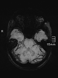 File:Amyotrophic lateral sclerosis (Radiopaedia 70821-81017 Axial SWI minIP 9).jpg
