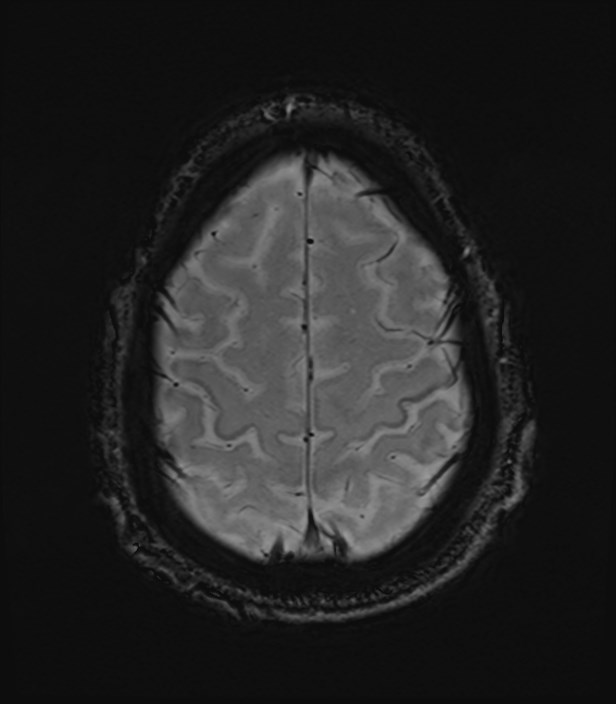 Amyotrophic lateral sclerosis (Radiopaedia 87352-103658 Axial SWI 55).jpg
