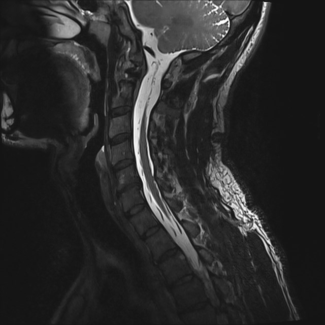 Amyotrophic lateral sclerosis (Radiopaedia 87352-103658 I 39).jpg