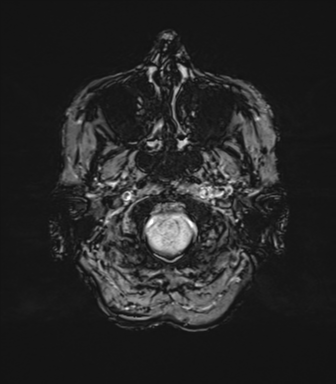 File:Anaplastic astrocytoma (Radiopaedia 86943-103160 Axial SWI 11).png