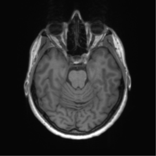 File:Anaplastic astrocytoma - thalamic glioma (Radiopaedia 59709-67115 Axial T1 3).png