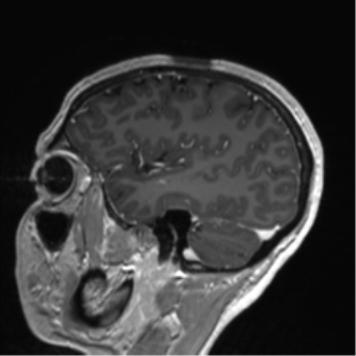 Anaplastic astrocytoma IDH mutant (Radiopaedia 50046-55341 Sagittal T1 C+ 47).png