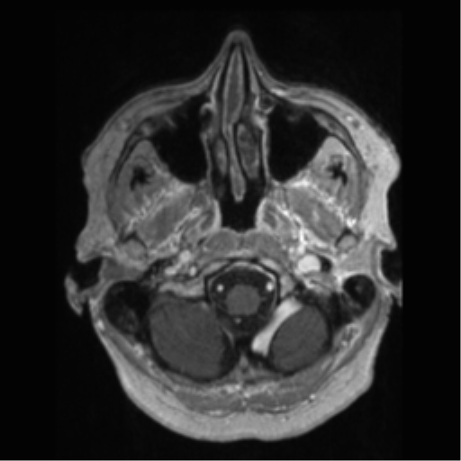 File:Anaplastic astrocytoma IDH wild-type (pseudoprogression) (Radiopaedia 42209-45277 Axial T1 C+ 9).png