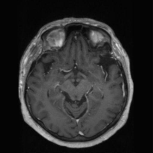 File:Anaplastic astrocytoma IDH wild-type (pseudoprogression) (Radiopaedia 42209-45278 Axial T1 C+ 70).png