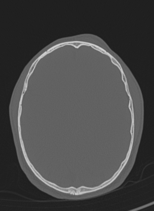 Anaplastic oligodendroglioma with skull fracture (Radiopaedia 74831-85846 Axial bone window 20).png