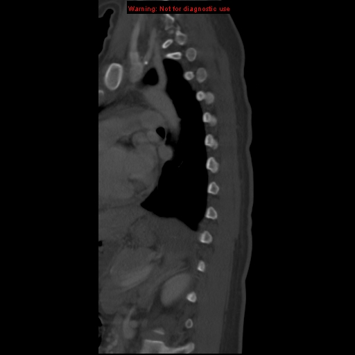 File:Aneurysmal bone cyst (Radiopaedia 9419-10102 Sagittal bone window 17).jpg