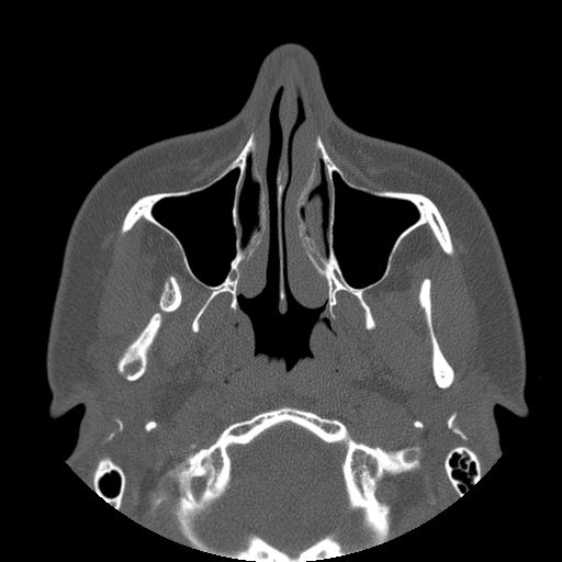 Aneurysmal bone cyst of the mandible (Radiopaedia 43280-46823 Axial bone window 120).jpg