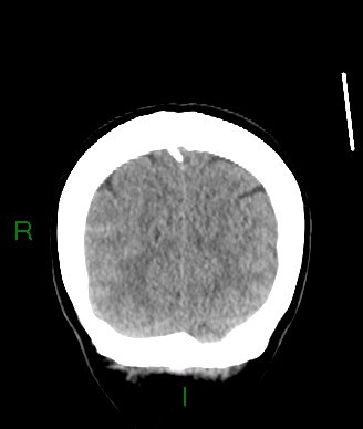 Aneurysmal subarachnoid hemorrhage with intra-axial extension (Radiopaedia 84371-99699 Coronal non-contrast 14).jpg