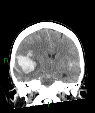 Aneurysmal subarachnoid hemorrhage with intra-axial extension (Radiopaedia 84371-99699 Coronal non-contrast 37).jpg