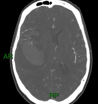 File:Aneurysmal subarachnoid hemorrhage with intra-axial extension (Radiopaedia 84371-99732 A 18).jpg