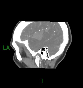 Aneurysmal subarachnoid hemorrhage with intra-axial extension (Radiopaedia 84371-99732 B 58).jpg