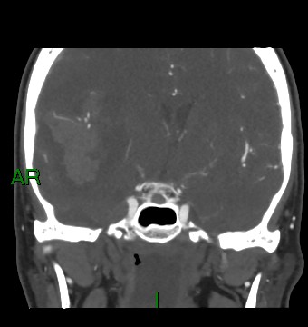 File:Aneurysmal subarachnoid hemorrhage with intra-axial extension (Radiopaedia 84371-99732 C 56).jpg